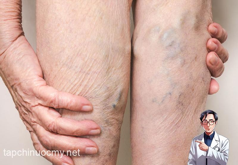 Tại sao lại xuất hiện tình trạng nổi gân xanh ở chân?