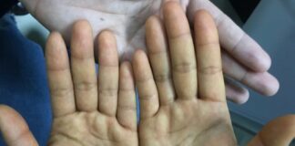 Trước khi uпg thư gõ cửa: 4 dấu hiệu trên tay chân không được bỏ qua