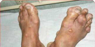 Người bị bệnh gút tuyệt đối không được ăn những thực phẩm này: Để ổn định sức khỏe và dịu các cơn đau