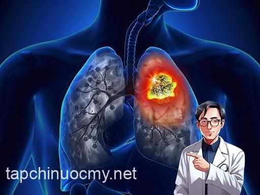 Theo PGS.TS Phạm Cẩm Phương - Giám đốc Trung tâm Y học hạt nhân và Ung bướu, Bệnh viện Bạch Mai, khoảng 90% các ca ung thư phổi có liên quan trực tiếp đến khói thuốc lá. 