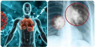 90% ca u ng th ư phổi ở nam giới Việt: Thói quen này là thủ phạm chính bạn cần biết!