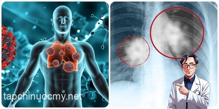 Việc phát hiện ung thư phổi ở giai đoạn sớm (giai đoạn I, khi khối u còn nhỏ hơn 4cm và chưa di căn) có thể giúp nâng tỷ lệ sống thêm 5 năm lên đến 90%.