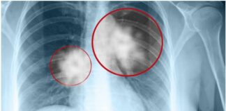 9 dấu hiệu UT ph:ổi giai đoạn đầu bạn không nên b:ỏ qua