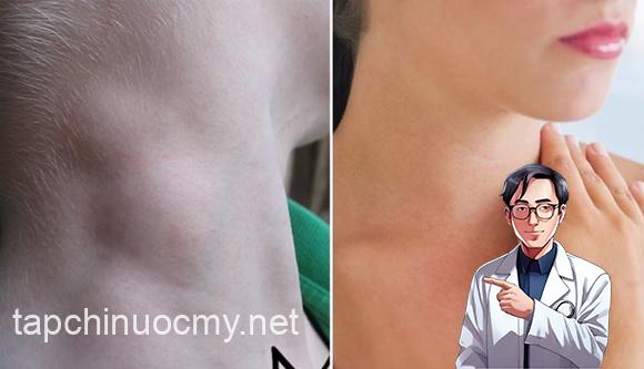 ung thư vòm họng, dấu hiệu ung thư vòm họng