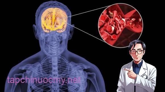 nhồi máu não, sức khỏe, chăm sóc sức khỏe, nguyên nhân gây nhồi máu não, thủ phạm gây nhồi máu não