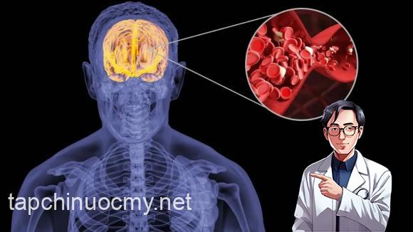 nhồi máu não, sức khỏe, chăm sóc sức khỏe, nguyên nhân gây nhồi máu não, thủ phạm gây nhồi máu não