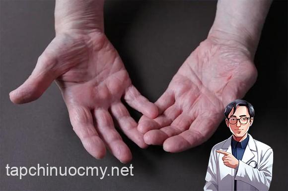ung thư gan