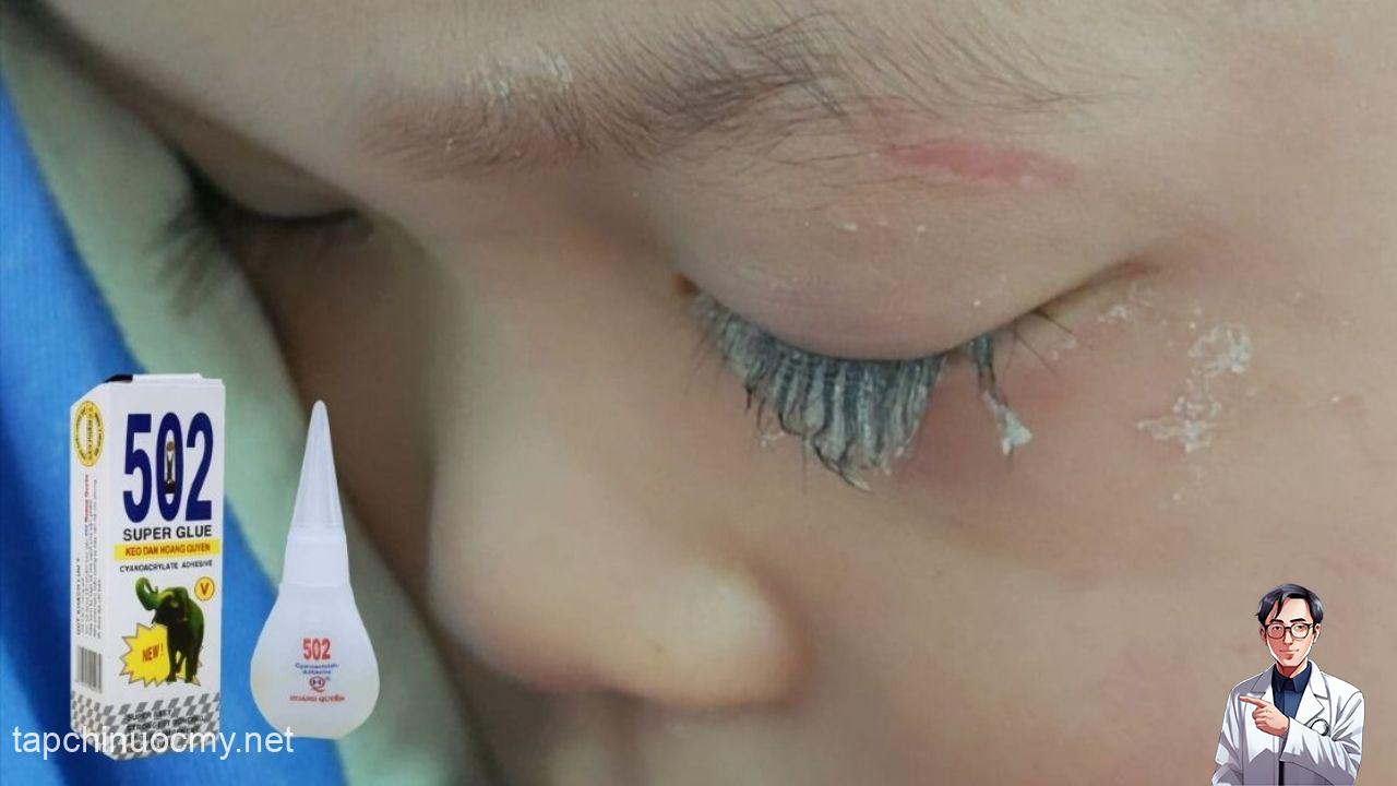 Bé trai 3 tuổi bị keo 502 bắn vào mắt, hành động của người mẹ trong “30 giây vàng” đã cứu con khỏi cảnh mù loà!- Ảnh 1.