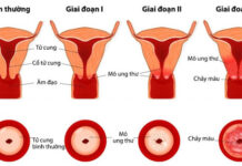 Người vợ 38 tuổi bị UT cổ tử cung vì chiều theo “sở thích” của chồng: Dù yêu chồng đến mấy vẫn cần tỉnh táo
