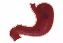 Cơ thể xuất hiện 4 điều bất thường này, rất có thể ung thư dạ dày đã gõ cửa, hãy cẩn trọng