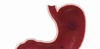 Cơ thể xuất hiện 4 điều bất thường này, rất có thể ung thư dạ dày đã gõ cửa, hãy cẩn trọng