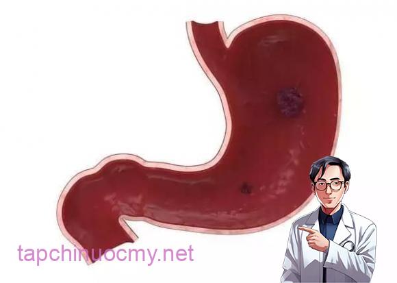 Cơ thể xuất hiện 4 điều bất thường này, rất có thể ung thư dạ dày đã gõ cửa, hãy cẩn trọng