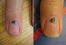 Cảnh báo sức khỏe: 6 bộ phận màu đen thường báo hiệu nguy cơ u.n.g t.h.ư, đừng chủ quan!