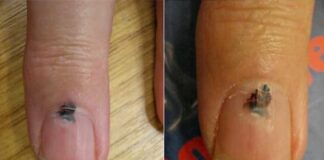 Cảnh báo sức khỏe: 6 bộ phận màu đen thường báo hiệu nguy cơ u.n.g t.h.ư, đừng chủ quan!