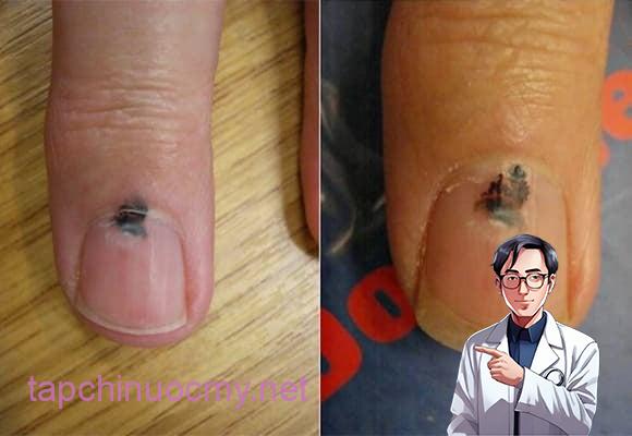 Nếu trên móng tay hoặc móng chân xuất hiện đường sọc hoặc mảng màu đen/nâu sẫm chạy dọc mà không phải do chấn thương, đây có thể là dấu hiệu của ung thư hắc tố dưới móng (Subungual Melanoma).