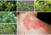 6 mẹo dân gian giúp điều trị bệnh Zona thần kinh tại nhà hiệu quả.