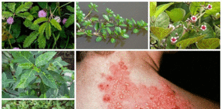 6 mẹo dân gian giúp điều trị bệnh Zona thần kinh tại nhà hiệu quả.