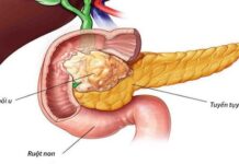 Ung thư lúc đầu không đau nhưng thấy 8 dấu hiệu khi đi vệ sinh thì nên đi khám sớm: Đừng chủ quan