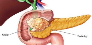 Ung thư lúc đầu không đau nhưng thấy 8 dấu hiệu khi đi vệ sinh thì nên đi khám sớm: Đừng chủ quan