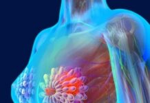 3 lý do khiến căn bệnh uпg thư vú ‘soán ngôi’ uпg thư gan, phổi tại Việt Nam