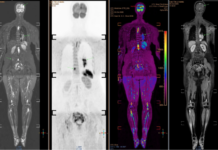 Mắc ungthư giai đoạn cuối di căn não, người phụ nữ đi khám, òa khóc khi biết “thủ phạm” đến từ chồng con