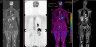 Mắc ungthư giai đoạn cuối di căn não, người phụ nữ đi khám, òa khóc khi biết “thủ phạm” đến từ chồng con