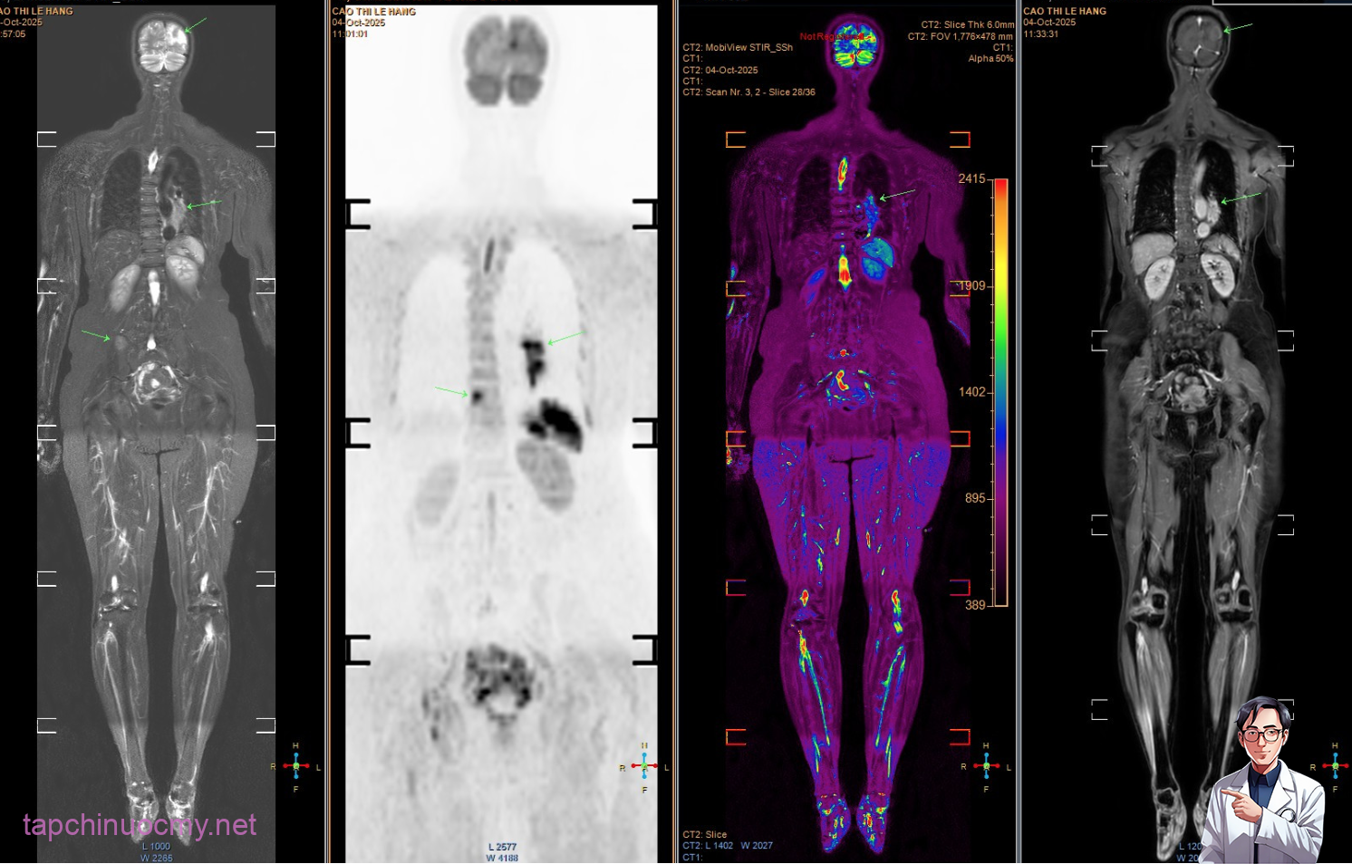 Mắc ung thư giai đoạn cuối di căn não, người phụ nữ đi khám, òa khóc khi biết “thủ phạm” đến từ chồng con- Ảnh 1.
