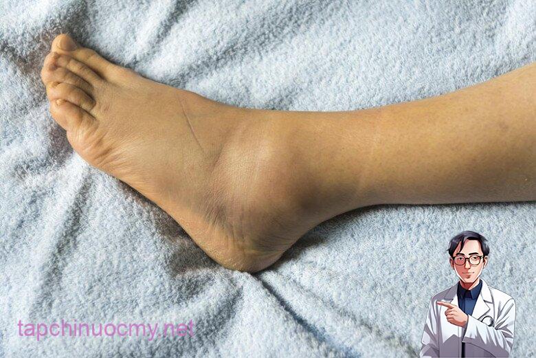 Màu da tay chȃn thay ᵭổi có thể là dấu hiệu của bệnh ung thư phổi - Ảnh minh họa.