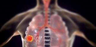 9 dấu hiệu u ng thư phổi giai đoạn đầu, đừng lơ là kẻo di căn nguy h iểm