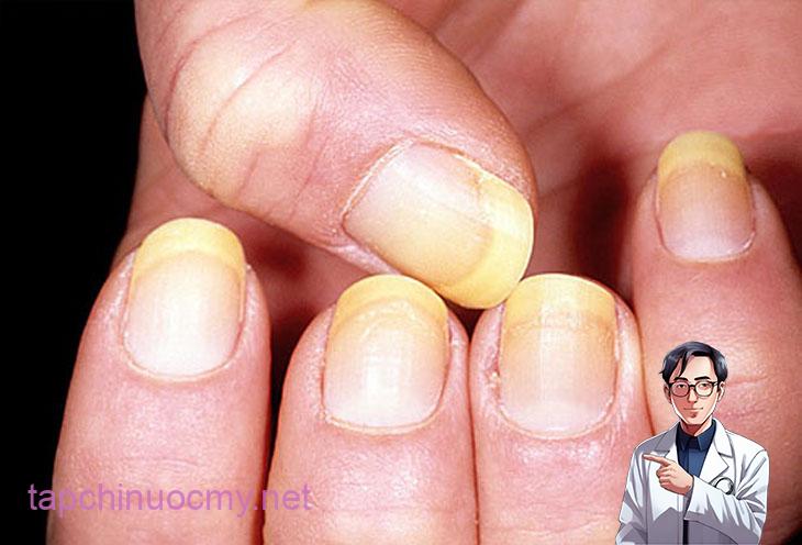 3 thay đổi NHỎ trên bàn tay nhưng là cảnh báo LỚN về lá gan của bạn đang hỏng