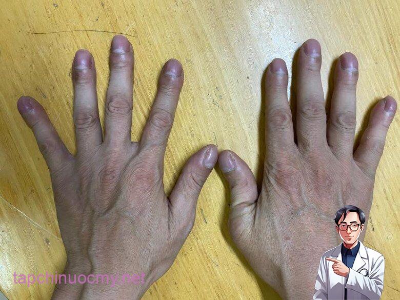 Ngón tay dùi trṓng của người bệnh ung thư phổi - Ảnh minh họa.