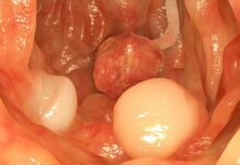 Cảnh báo dấu hiệu khi đi ngoài chứng tỏ cơ thể đã bị ung thư đại tràng, cần đi khám gấp