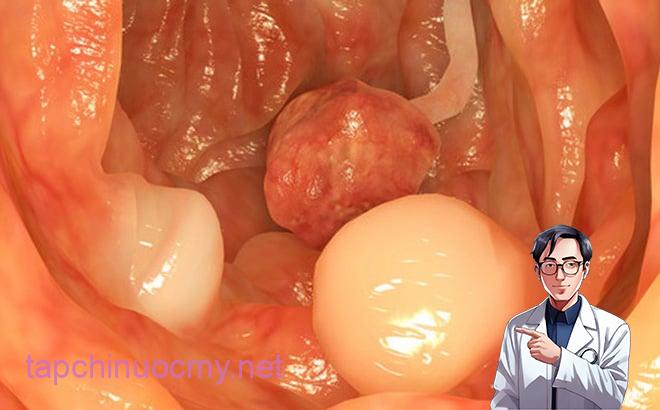 Cảnh báo dấu hiệu khi đi ngoài chứng tỏ cơ thể đã bị ung thư đại tràng, cần đi khám gấp