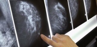 Người phụ nữ ở Hà Nội mắc u-ng thư v-ú cả 2 bên cùng lúc: Thừa nhận bỏ qua 2 dấu hiệu lớn