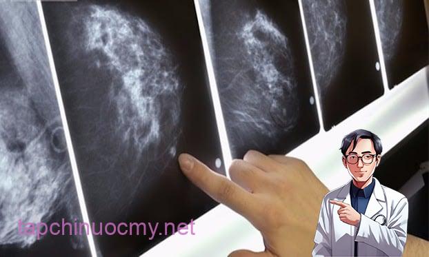 Người phụ nữ bị ung thư cả 2 bên vú 