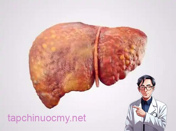 ung-thu-gan (1).jpg 6