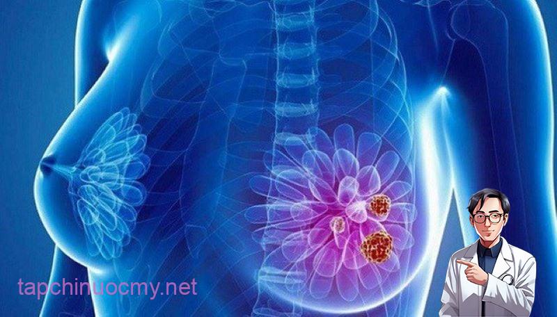 2 thói quen cực xấu của chồng khiến vợ dễ mắc ung thư vú, bỏ ngay kẻo ân hận cả đời