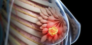 8 kiểu phụ nữ dễ bị K vú nhất: Xem bạn có trong số đó?