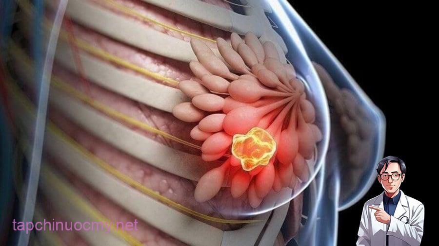 8 kiểu phụ nữ dễ bị K vú nhất: Xem bạn có trong số đó?