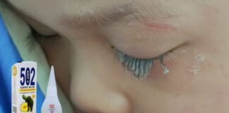 Bé trai 3 tuổi bị keo 502 bắn vào mắt, hành động của người mẹ trong “30 giây vàng” đã cứu con khỏi cảnh mù loà!