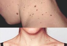 Người sắp bị K tấn công thường có 3 dấu hiệu lạ ở cổ, có dù chỉ 1 cũng báo động sức khoẻ