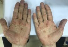 Hàng chục nghìn người nhiễm giun đũa ch;ó m;èo mỗi năm, nguyên nhân do đâu