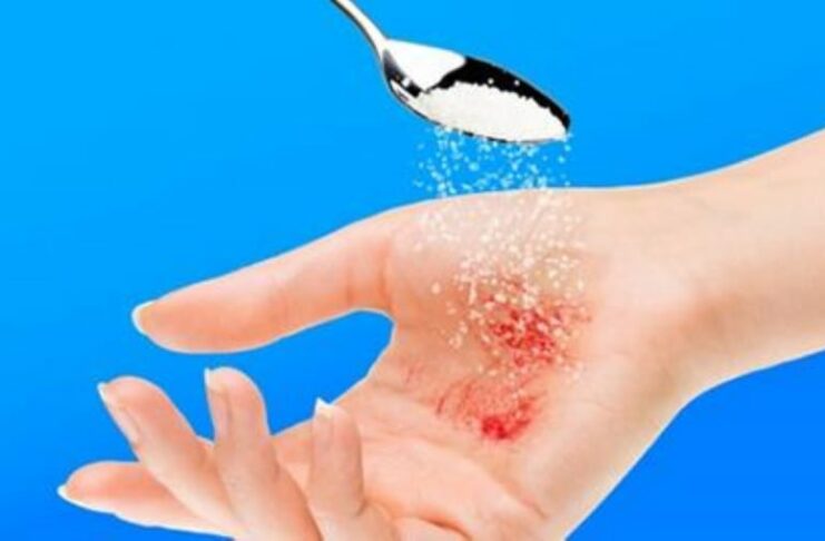 Chỉ với một ít đường bạn có thể trị được ngay vết thương lở loét