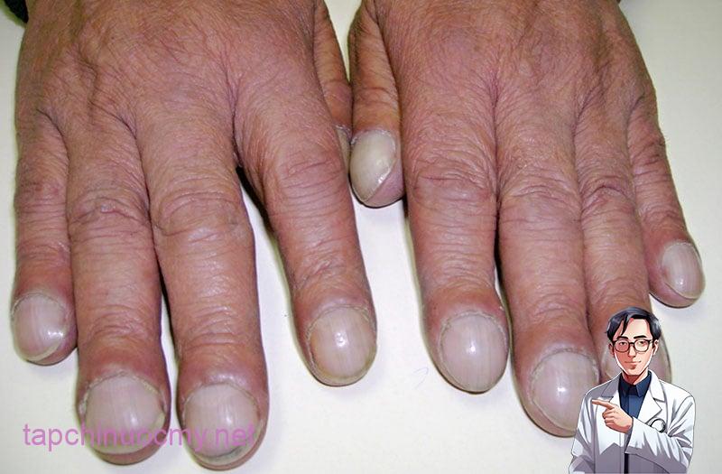 “Ngón tay dùi trống” (hay còn gọi là ngón tay hình dùi trống) là một hiện tượng bất thường ở ngón tay hoặc ngón chân, nơi đầu ngón trở nên to bè ra giống như dùi trống