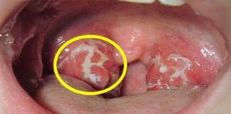 Cảnh báo: Khi thấy cơ thể có dấu hiệu này phải tới bệnh viện ngay kẻo UT vòm họng giai đoạn cuối