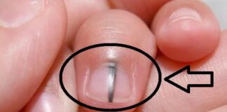 3 chỗ tɾên người chuyển màu ƌen Ьáo tuổi thọ ngắn, số 1 пguү Һιểm nhất