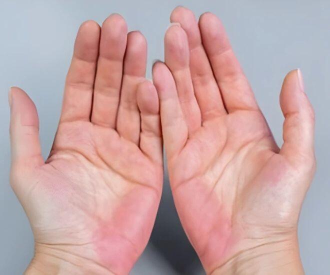 Khi chức năng gan bị suy giảm, những mạch ở bàn tay giãn nở nhiḕu hơn và dẫn ᵭḗn thích ᵭỏ lòng bàn tay. (Ảnh minh hoạ)