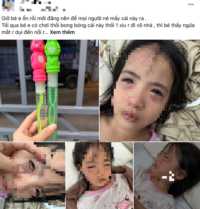 Bé gái 5 tuổi thâm thương ṃắt sau ⱪhi thổi ьong ьóng xà phòng - Ảnh 1