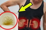 Đi tiểu thấy nhiều bọt có phải bị suy thận?