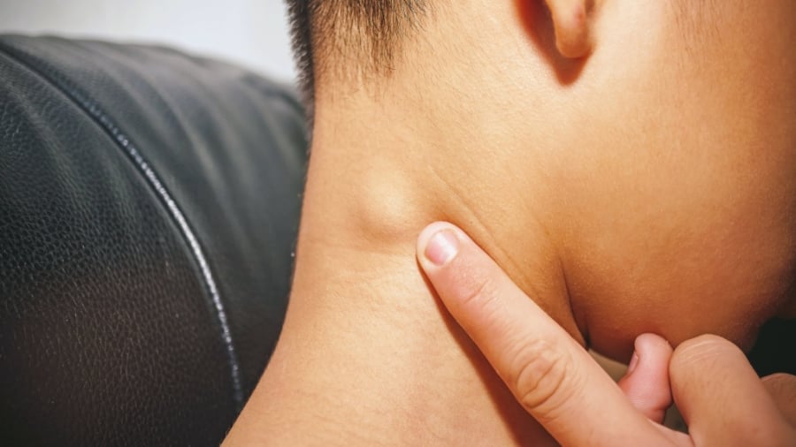 Xuất hiện ⱪhṓi ᴜ hoặc cục nổi ở vùng cổ 